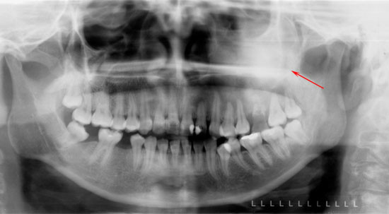 displasia fibrosa maxilar
