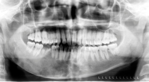 displasia fibrosa maxilar