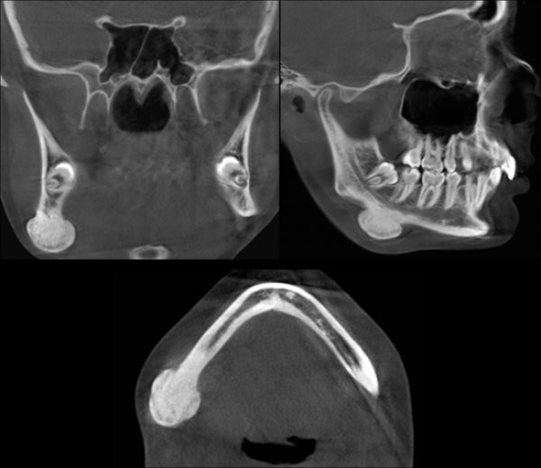 Caso 493 OSTEOMA PERIFÉRICO CDI