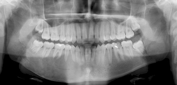 displasia fibrosa maxilar