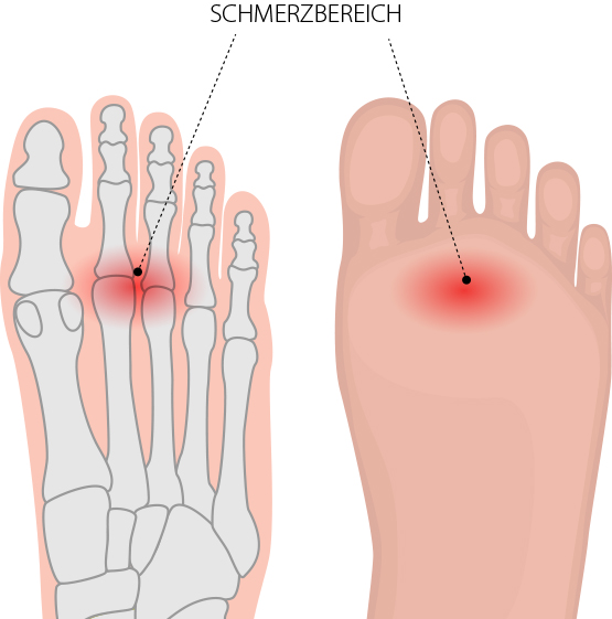 Spreizfuß Dr. med. Matthias Marquardt