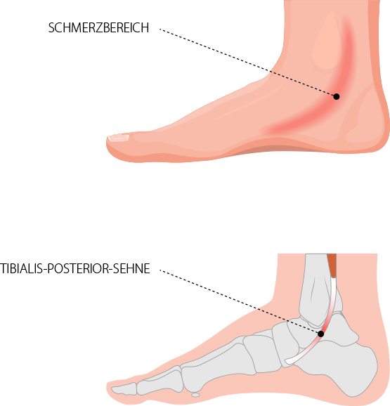 Sehnenscheidenentzündung des Innenknöchels Dr. med. Matthias Marquardt