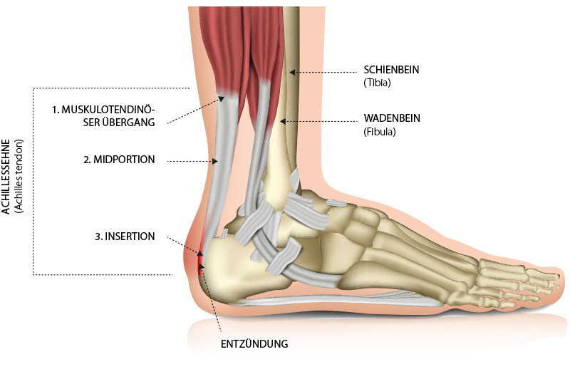 Achillessehnenansatzschmerz - Dr. med. Matthias Marquardt