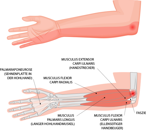 Golfer-Ellenbogen (Epicondylitis humeri ulnaris) – Dr. Matthias Marquardt