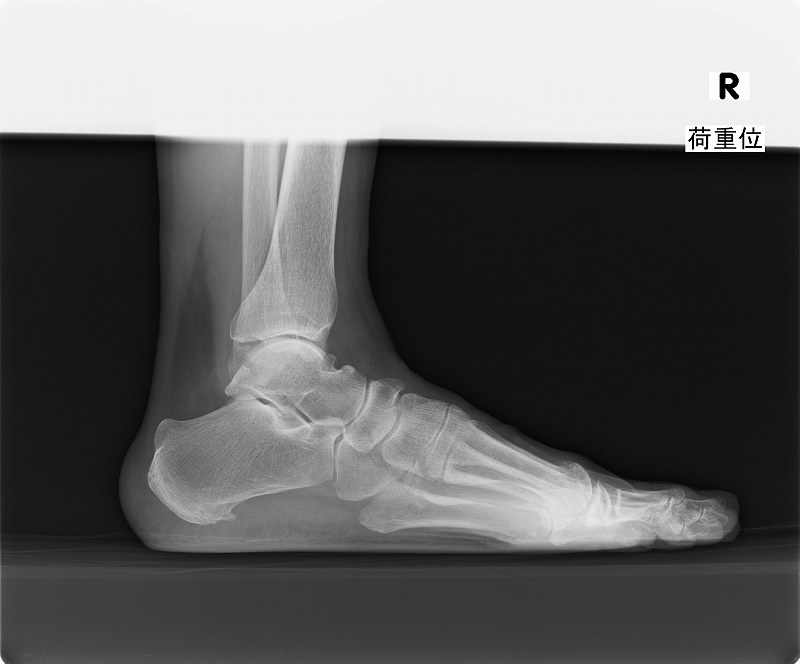 Cr 足関節と足の立位撮影 安全簡単撮影法 Rtcラジエーションルーム Radiological Tech Community Cr 足関節と足の立位撮影 安全簡単撮影法 Rtcラジエーションルーム Radiological Tech Community