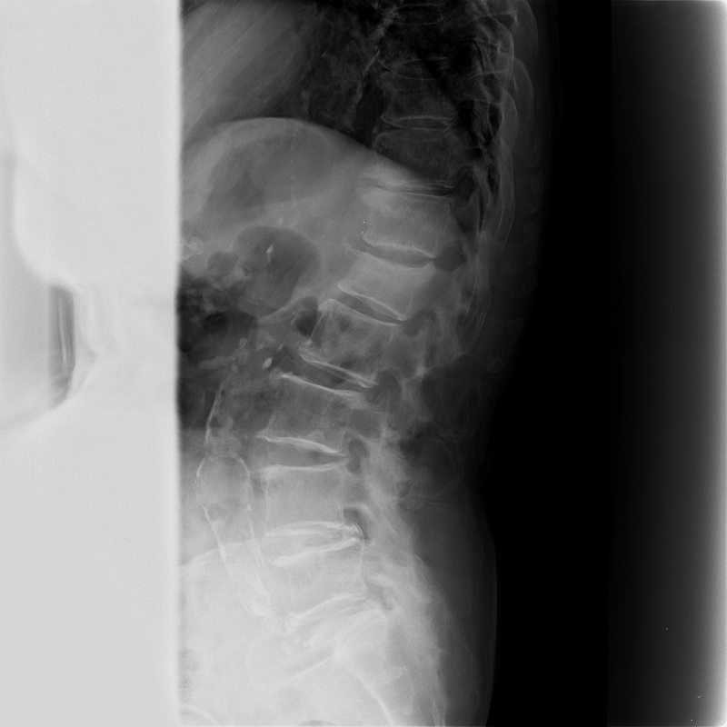 Cr 腰椎臥位撮影の向きと上げ底 Rtcラジエーションルーム Radiological Tech Community