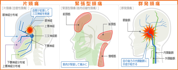 頭痛の種類と対策 頭痛専門 みこし頭痛整体院 頭痛の種類と対策 頭痛専門 みこし頭痛整体院