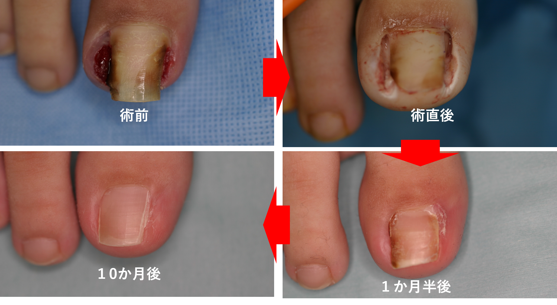 爪の異常、巻き爪・陥入爪治療 - 保険診療内容のご案内