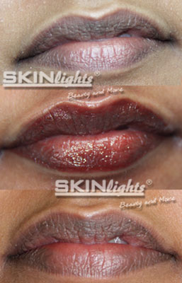 Permanent Make-up Lippen vorher / nachher / © katja junius - skinlights.de