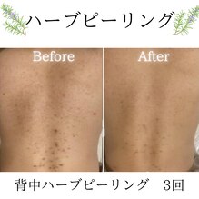 背中のニキビケア