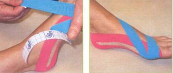 hallux valgus