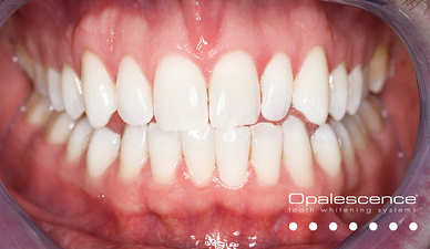 Bleaching (nachher) © Opalescence