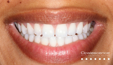 Bleaching (nachher) © Opalescence