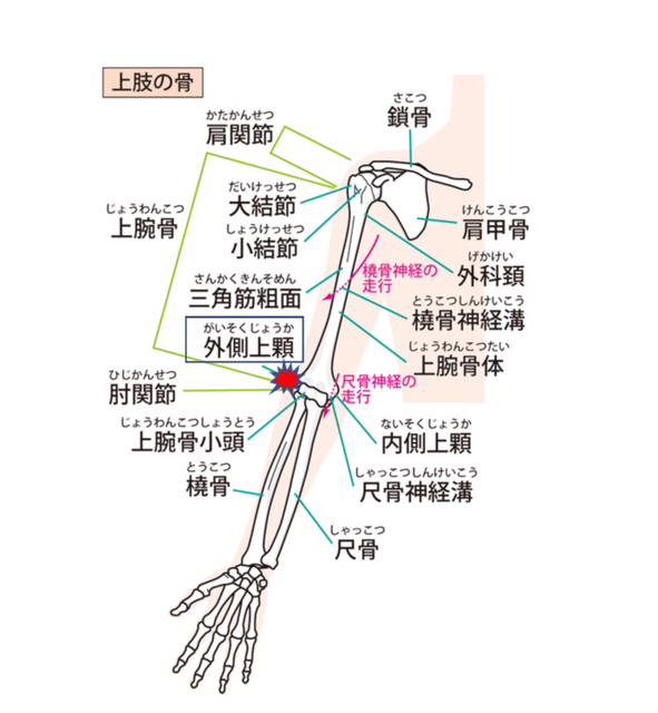 外側上顆の位置　肘の筋肉付着部にかかるストレスによって発生する外側上顆炎（テニス肘）