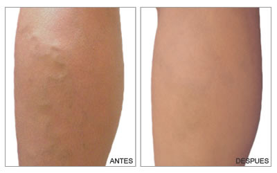 quitar las venas con laser