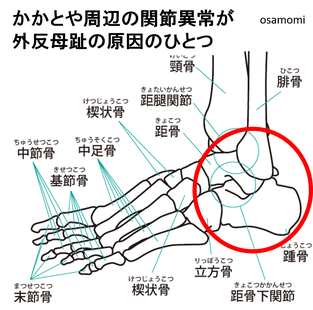 距骨下関節異常、外反母趾改善、昭島市のオサモミ整体院