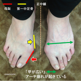 外反母趾の痛み解消、昭島市のオサモミ整体院