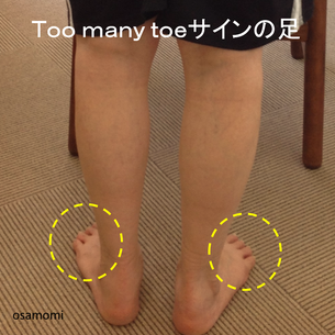 Ｔｏｏｍａｎｙサインの足、後脛骨筋腱の痛み、昭島市のオサモミ整体院