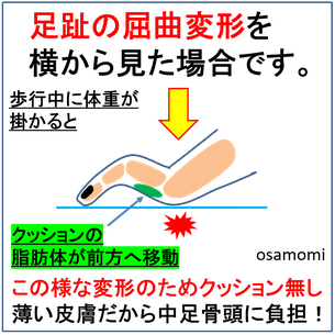 中足骨頭に負担が掛かる、脂肪体が前方移動、昭島市のオサモミ整体院