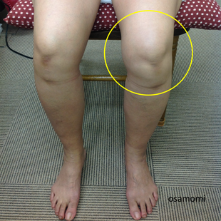 変形性膝関節症の痛みをサラシ固定で解消します。昭島市のオサモミ整体院