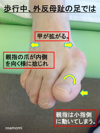 外反母趾が悪くなる歩き方