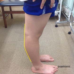反張膝の痛み解消、昭島市のオサモミ整体院