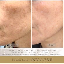 しみ、肝斑でお悩みの方へ