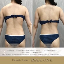 ラジオ波でより美しいドレス姿へ♪