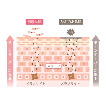 しみは再発ありき？！