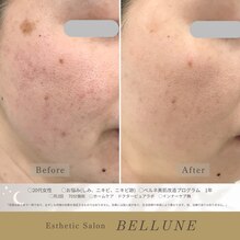 シミ爆弾ってご存知ですか