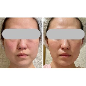 挙式までに手に入れるキュッ上がったフェイスライン♪