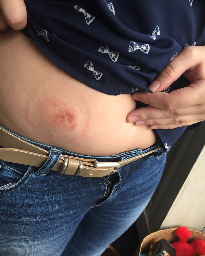 De plekken van de Omnipod