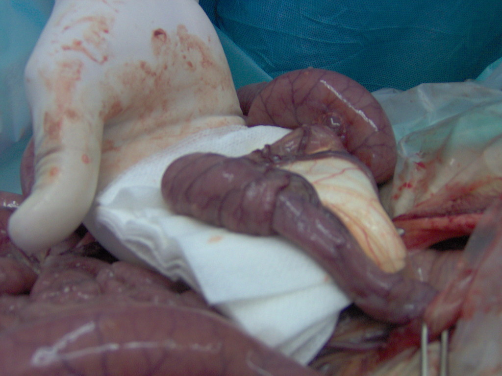Cirugia neonatal : Intosuspeccion intestinal