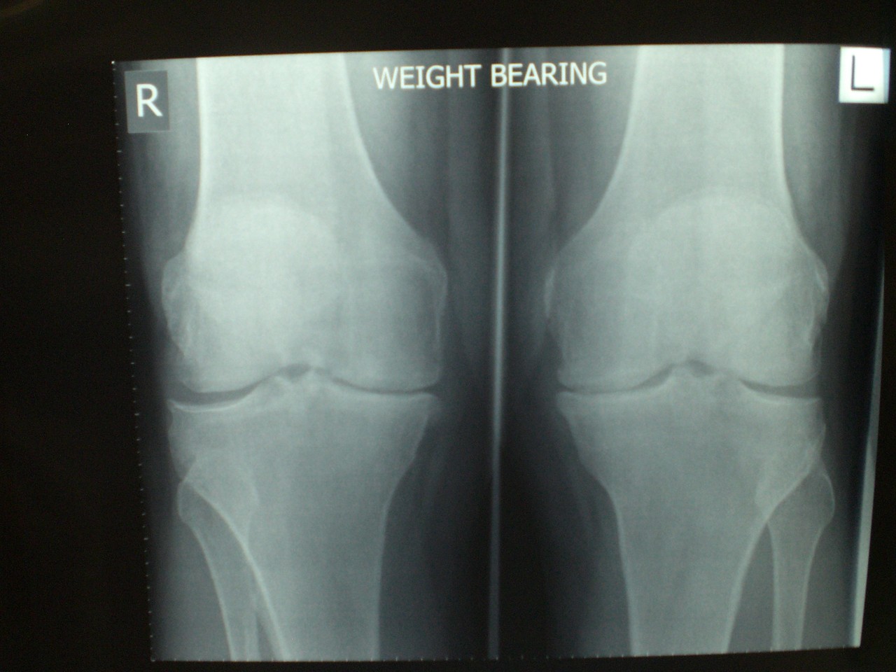 Osteoarthritis What Is It And What Can You Do Kniedoktor In Basel