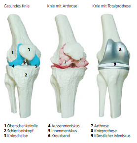 Symptome der Arthrose - Osteoarthritis - IBSA Switzerland