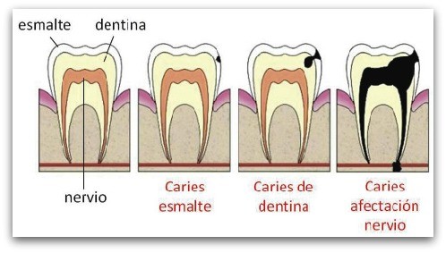 me duele una muela pero no tengo caries