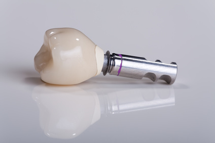 Zahnkrone auf einem Implantat