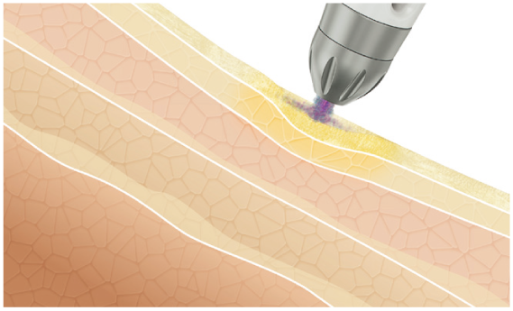 形成されたマイクロユニットは、一定周波に同調させ超音速で皮膚に適用されます。