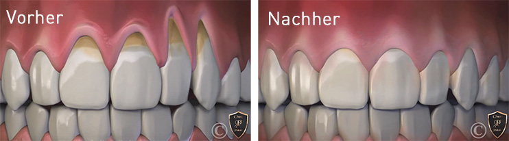 Zahnfleischlifting Pst Dr S Rassaf