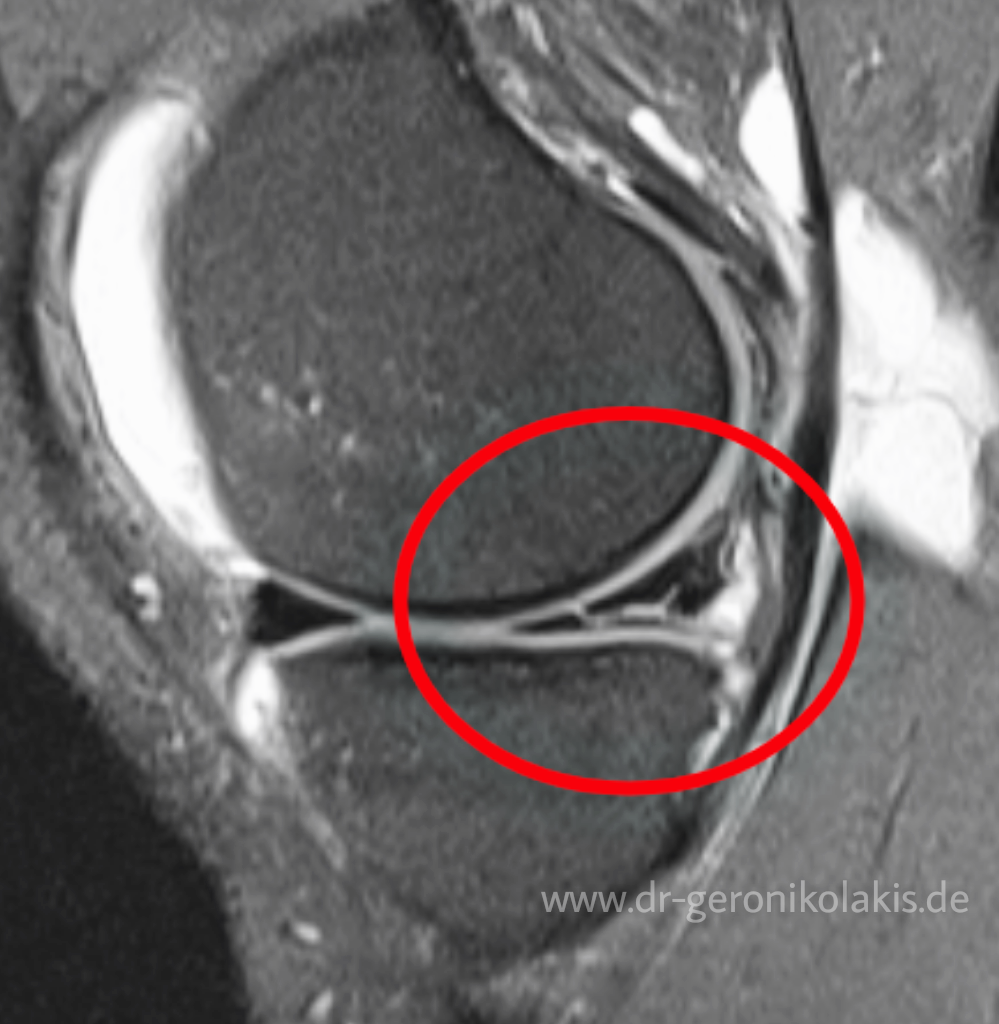 Meniskusriss Dr. Geronikolakis Facharzt für Orthopädie und Unfallchirurgie, Sportmedizin