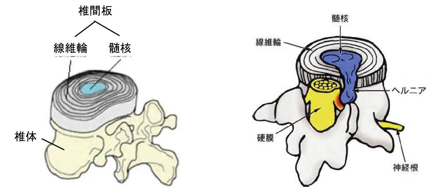 椎間板ヘルニア アスリート鍼灸整骨院 椎間板ヘルニア アスリート鍼灸整骨院