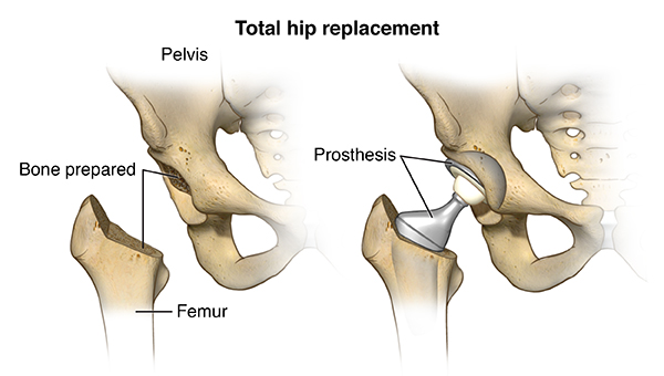 Hip & Knee Replacement Post-Op Treatment - Caravaggio ... body pain diagram for pt 