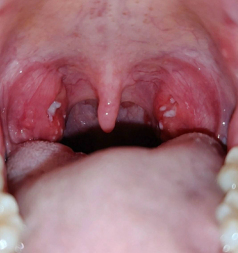 Typisches Bild bei akuter Tonsillitis (Halsentzündung, Mandelentzündung): Die Mandeln sind gerötet, geschwollen und weiß belegt.