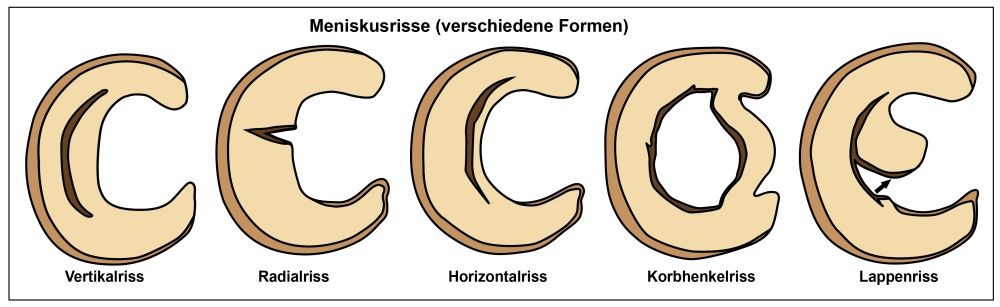 Schema verschiedener Meniskusrisse