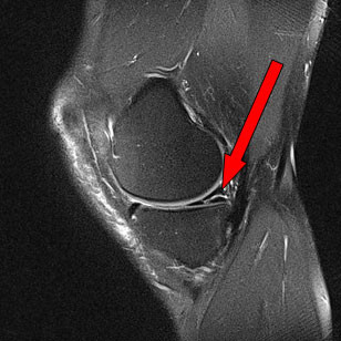 MRT-Bild eines Meniskusrisses