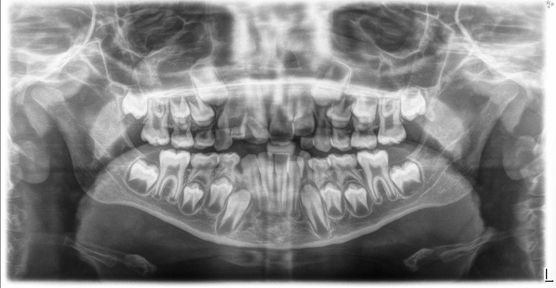 ortopantomografia delle arcate dentali