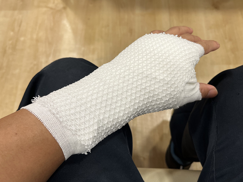 左手首(舟状骨)を骨折しました...