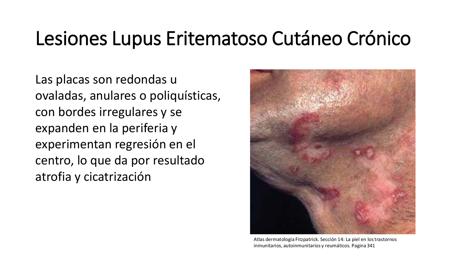 Lupus Eritematoso Discoide P gina Web De Pseudomonas lupus-eritematoso-discoide-p-gina-web-de-pseudomonas