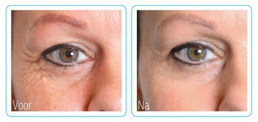 dermatude facelift alternatief alternative