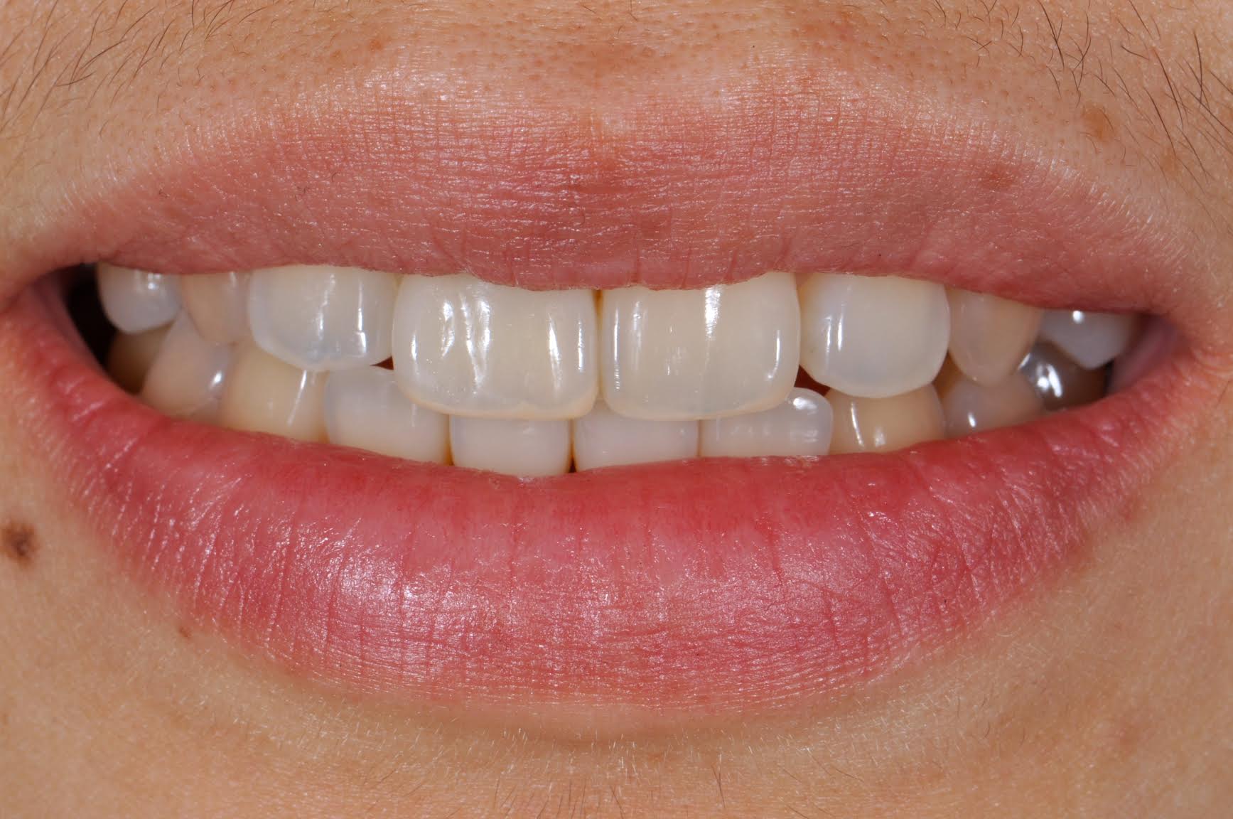 Case-3 After